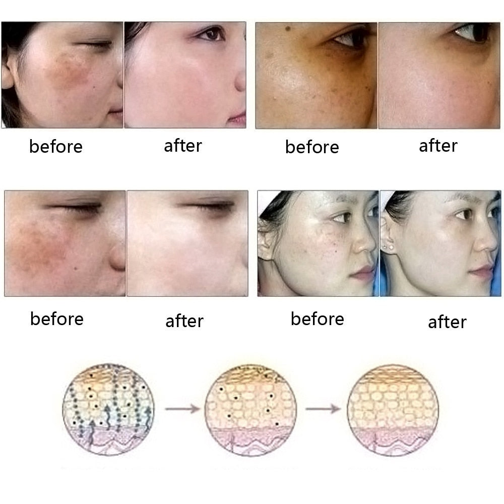 Acne/Scar Removal Oil